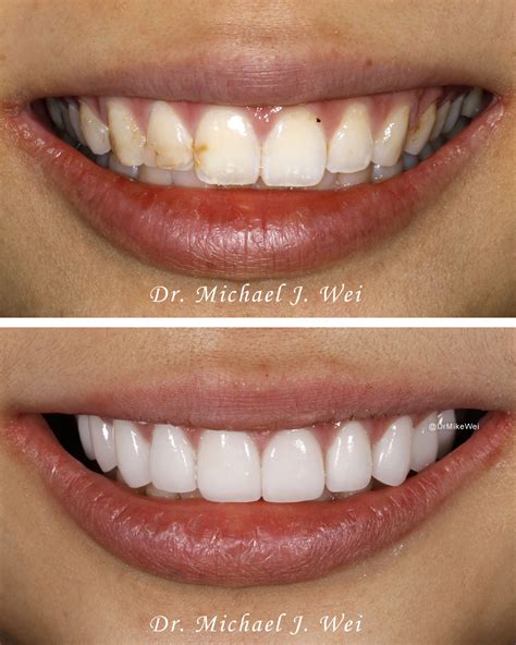 veneers for teeth cost.